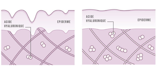 Evolution acide hyaluronique