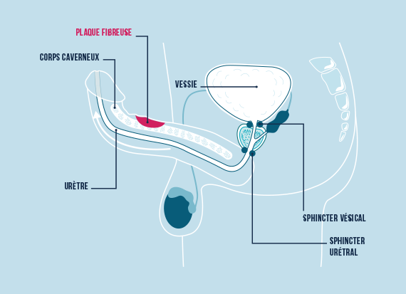 Schéma maladie de Lapeyronie, sexe courbé