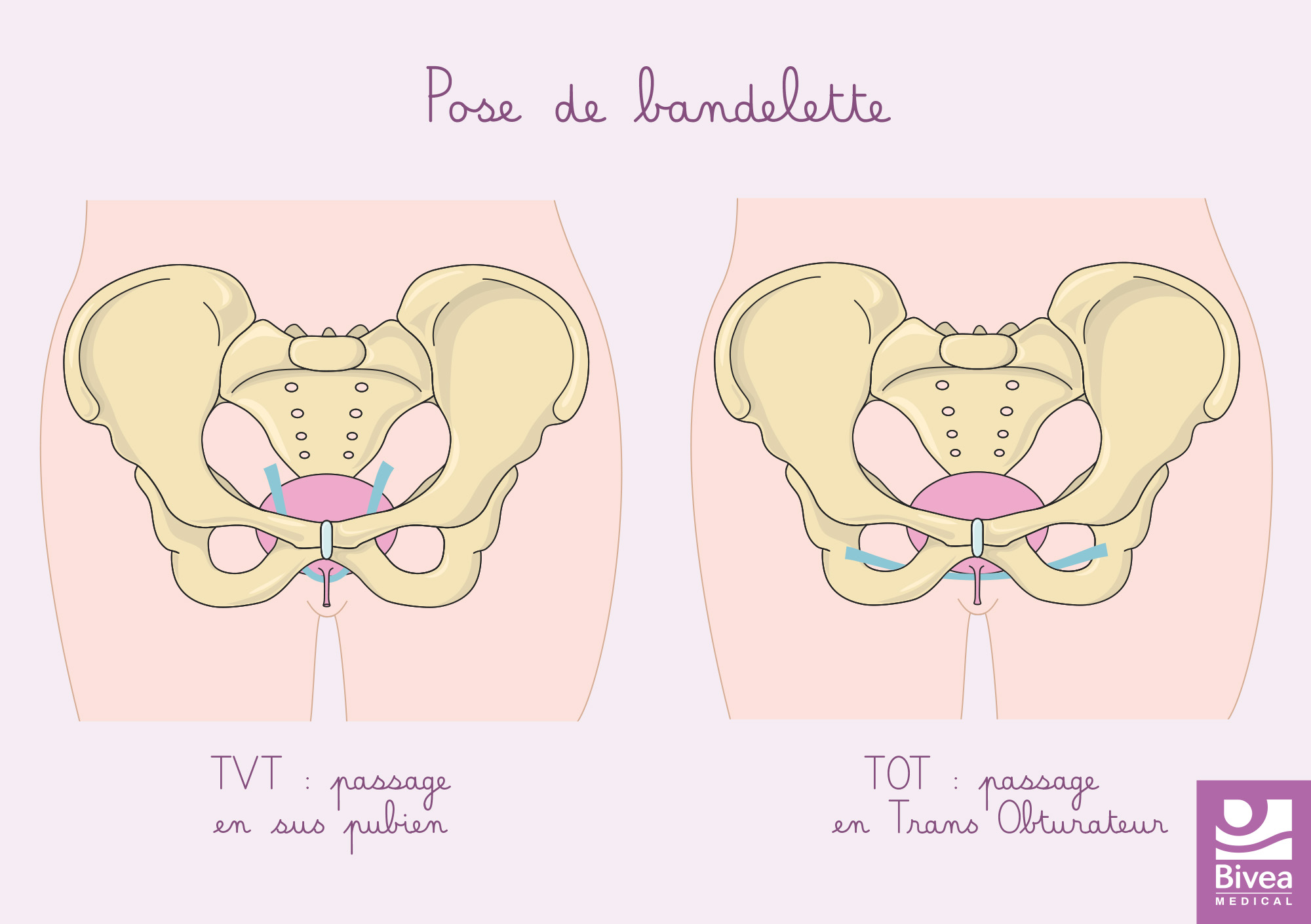 solution incontinence urinaire - chirurgie TVT