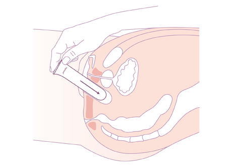 dilatation après vaginoplastie