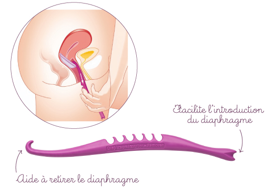 Applicateur diaphragme de différentes tailles