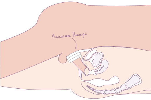 anneaux péniens Bumpi douleurs rapports 