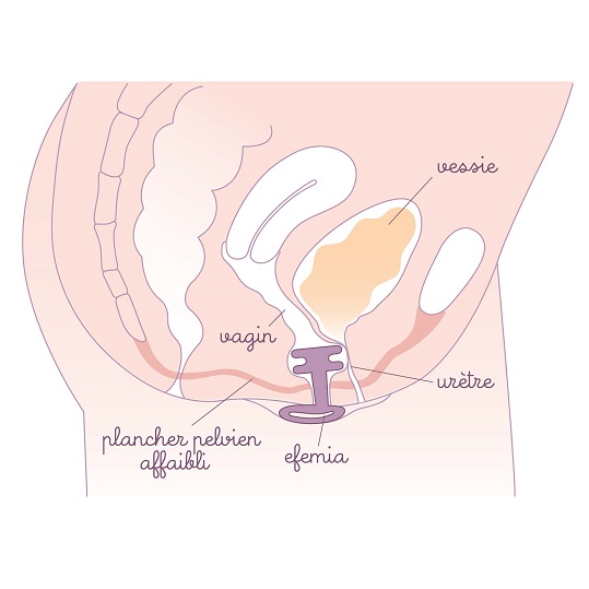 Utilisation du pessaire pour incontinence Efemia