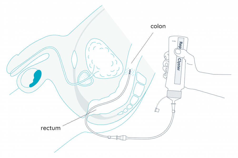 La Poire à lavement, pour un lavement intestinal à la maison