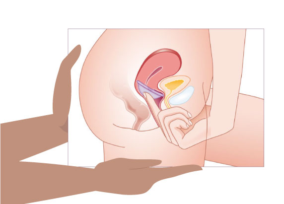 Caractéristiques du diaphragme contraceptif à différentes tailles Medintim