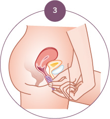 Diaphragme contraceptif Singa Etape 3 