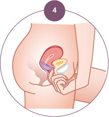 Diaphragme contraceptif Singa Etape 4