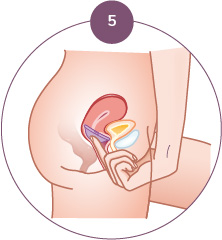 Diaphragme contraceptif Singa Etape 5 